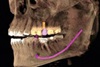 5 Gründe für Digitale Abformung mit Intraoralscanner:Einstieg in digitale Behandlungskonzepte